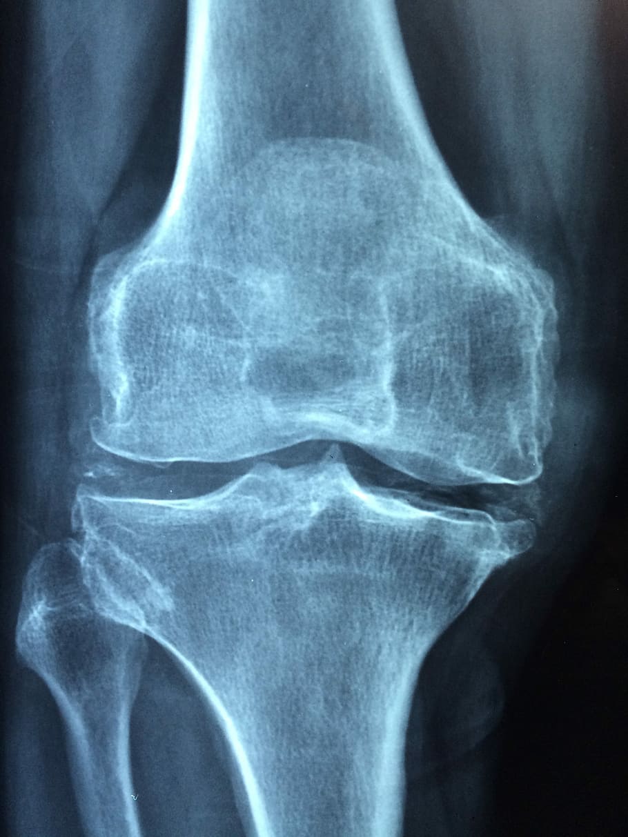 Knee Arthritis, human limb, leg, human joint, osteoporosis