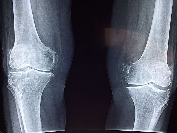 Knee Arthritis Symptoms, black background, fracture, therapist, human knee Free HD Wallpaper