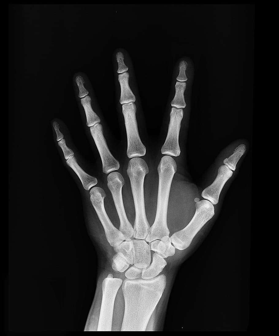 Left Hand X-ray, finger, human limb, human body part, black background Free HD Wallpaper